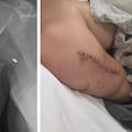 Nadia Beller difundió imágenes de sus heridas tras el atentado