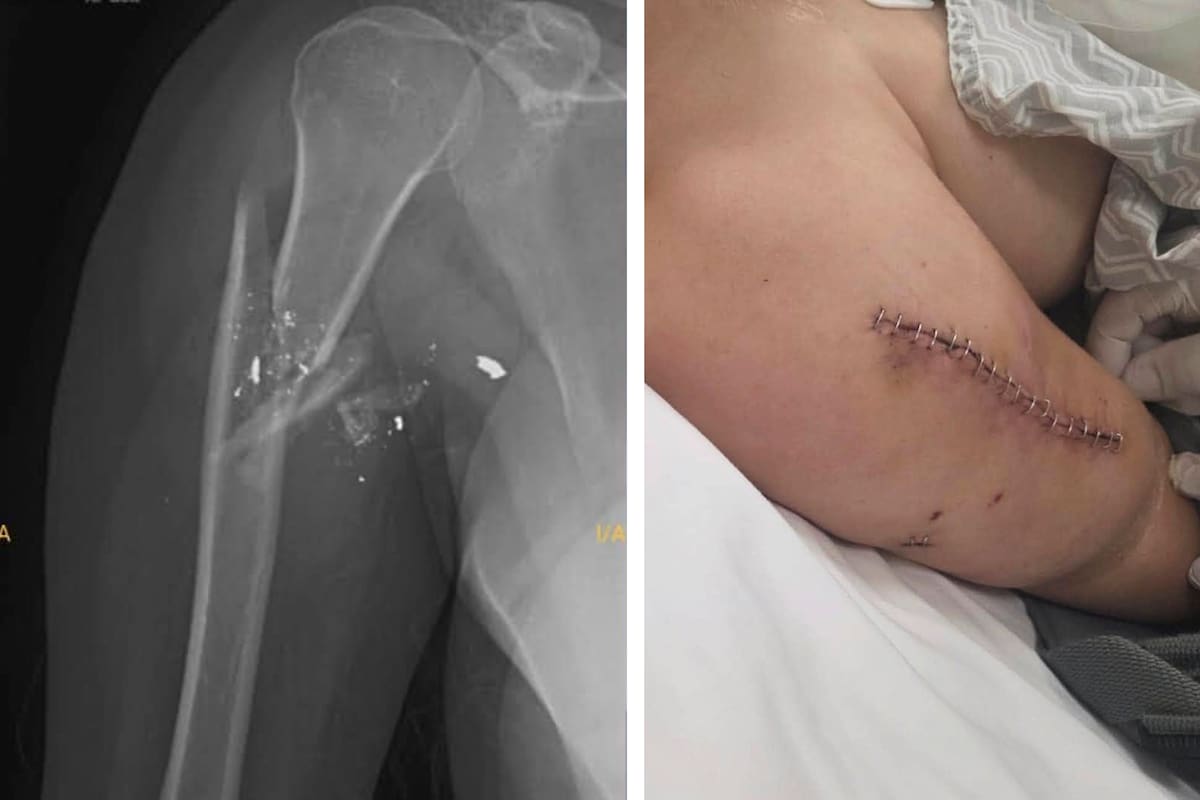 Una radiografía del brazo fracturado de Nadia Beller y de la sutura