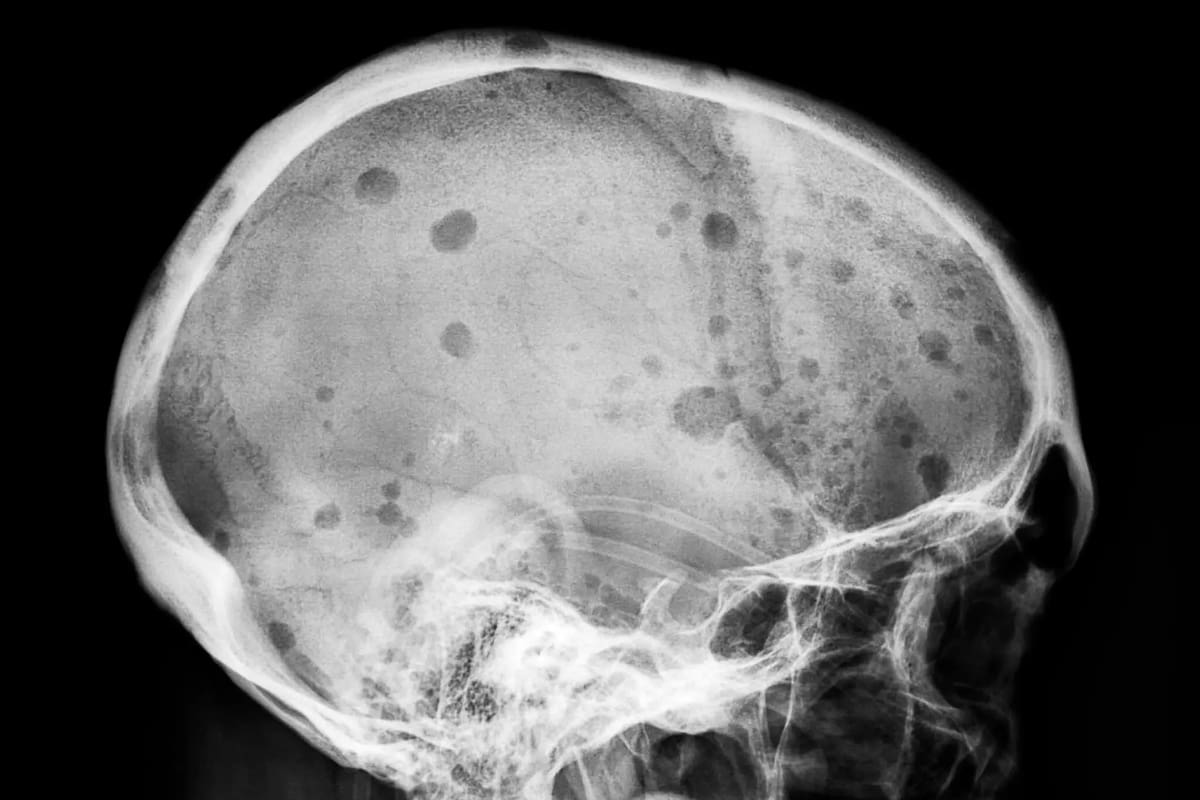 Una radiografía del cráneo de un paciente con mieloma múltiple, que muestra sus lesiones óseas reveladoras, en manchas oscuras