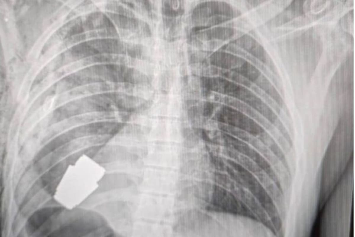 Una radiografía muestra lo cerca que se econtraba la granada del corazón del soldado ucraniano