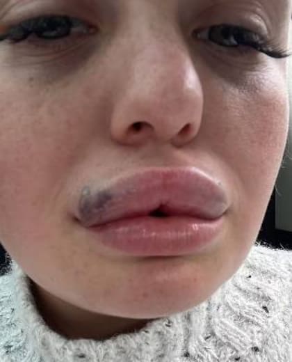 Una reacción alérgica le jugó una mala pasada