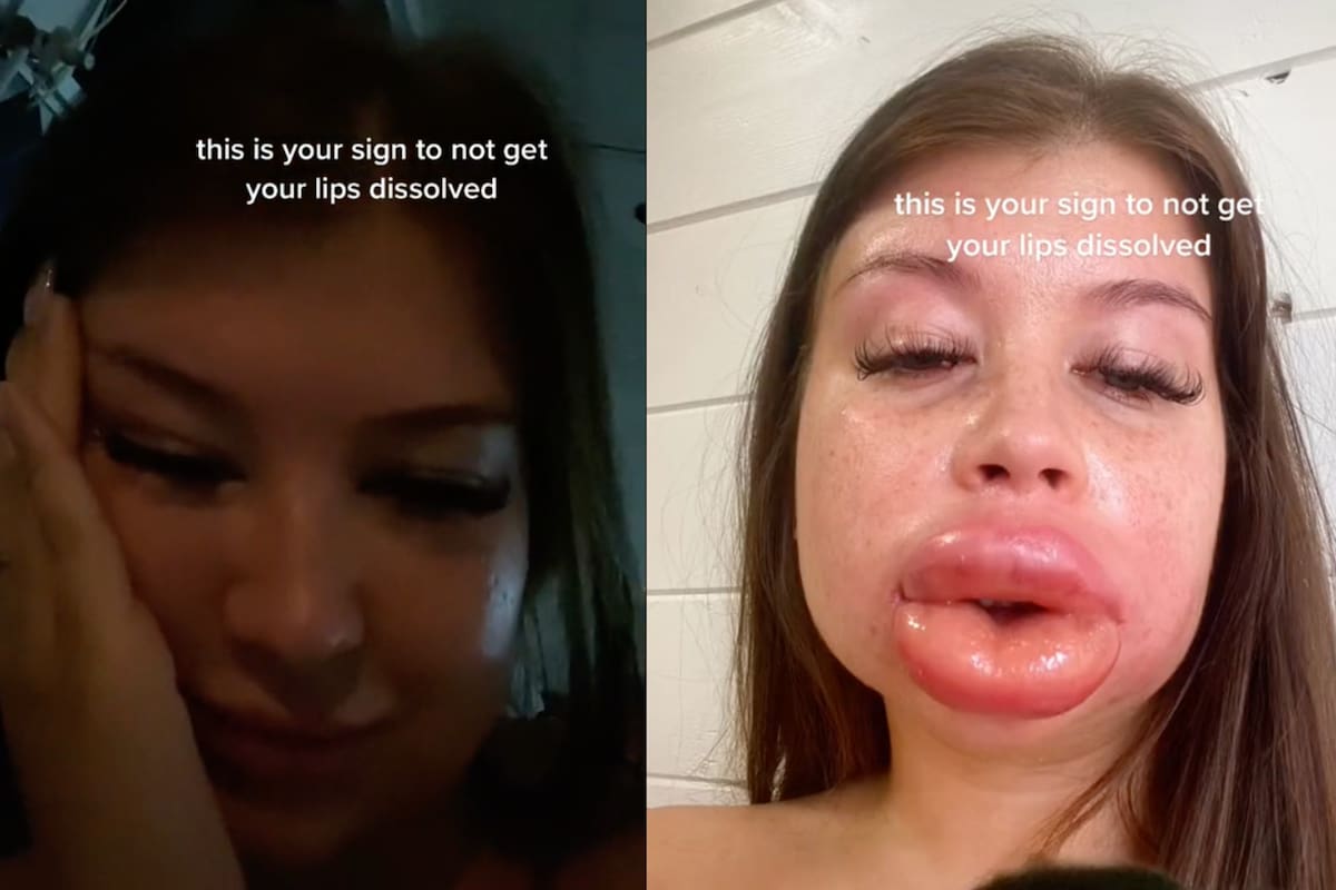 Una tiktoker obtuvo un resultado inesperado en su tratamiento de labios y alertó a todos