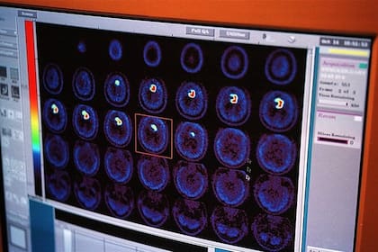 El estudio se basó en tomografías cerebrales de casi 40.000 adultos de entre 44 y 82 años que residen en Reino Unido