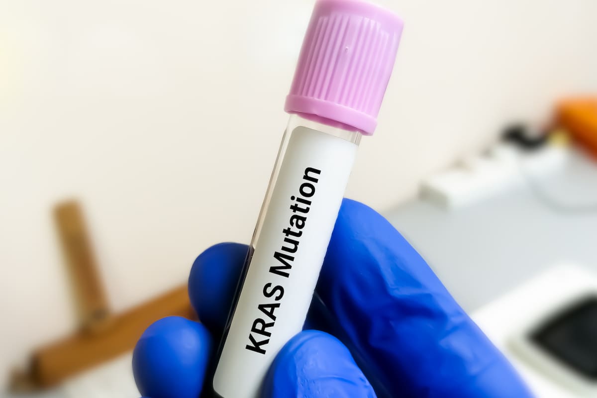 Uno de cada diez tumores está impulsado por mutaciones en el gen KRAS, descubierto en 1982