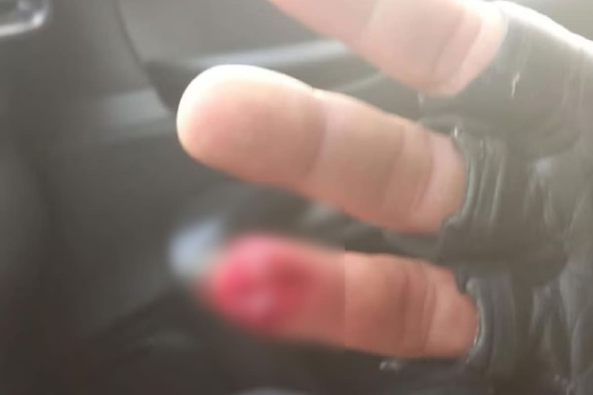 Uno de los oficiales presentes sufrió la amputación de la tercera falange del dedo anular