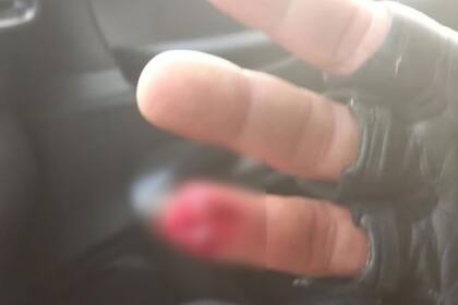 Uno de los oficiales presentes sufrió la amputación de la tercera falange del dedo anular