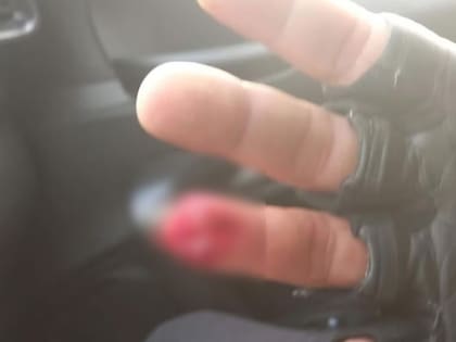 Uno de los oficiales presentes sufrió la amputación de la tercera falange del dedo anular