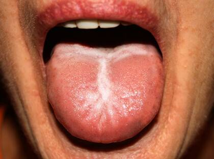 Uno de los síntomas de la sífilis son parches o manchas blancas en la boca, labios y lengua.