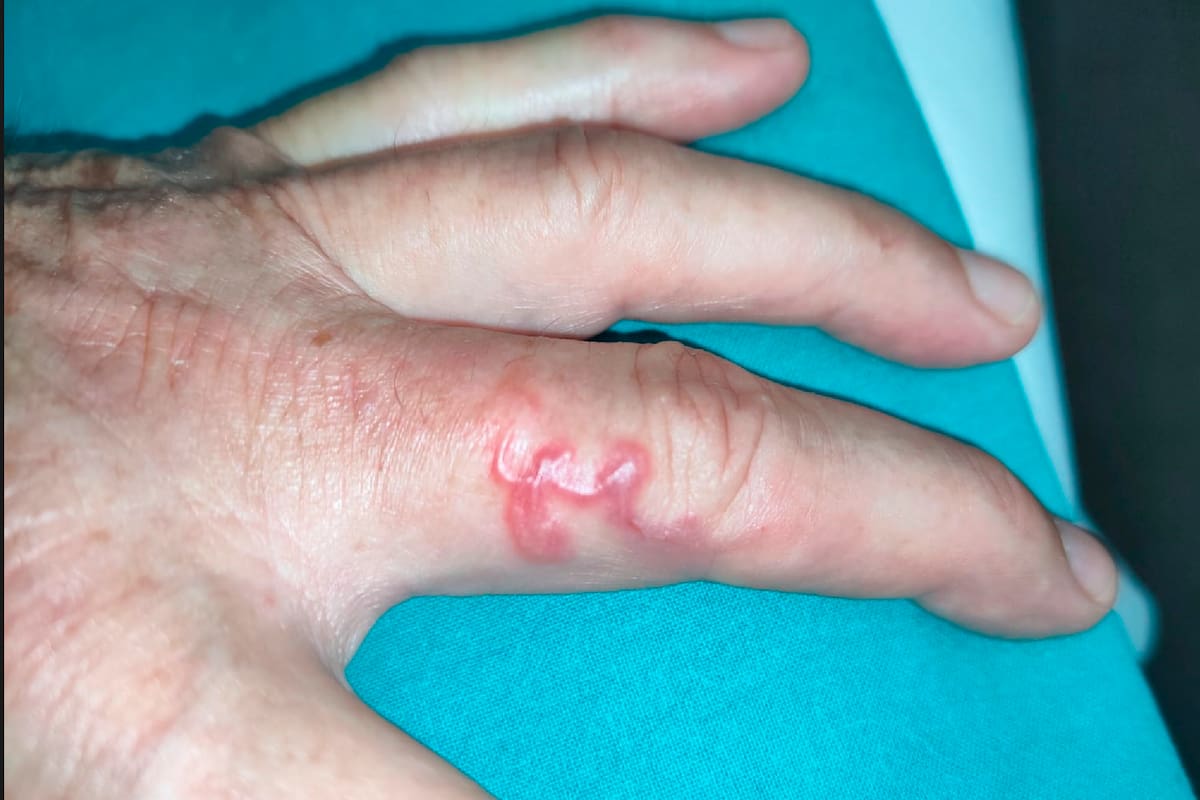 Uno de los últimos casos diagnosticados en España de larva migratoria cutánea