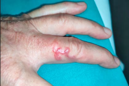 Uno de los últimos casos diagnosticados en España de larva migratoria cutánea