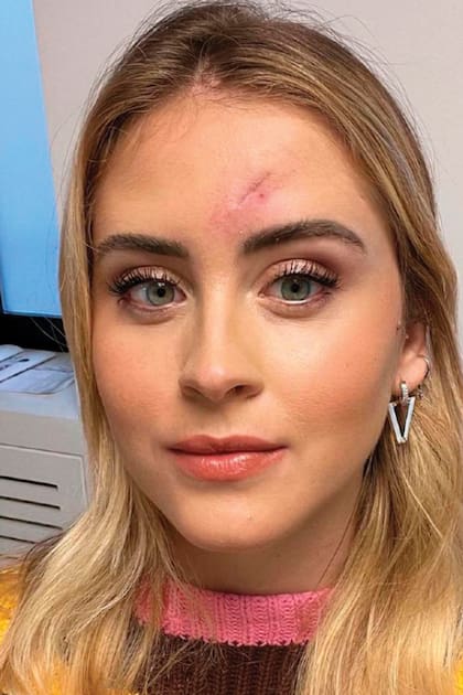 Valentina mostró en Instagram la cicatriz que le dejó la cirugía en la que le extirparon el quiste maligno.