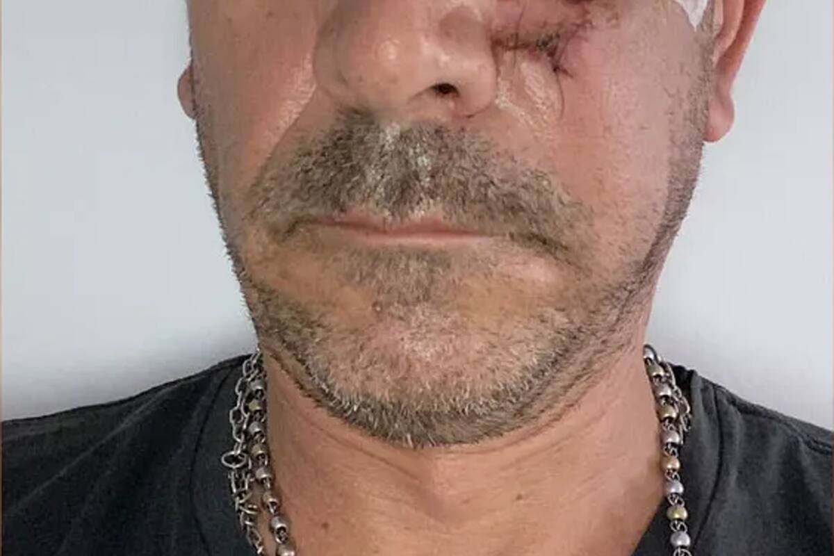 Violencia en Mendoza: le dijo que no necesitaba que le limpiara el vidrio del auto y el agresor lo atacó a palazos en uno de sus ojos