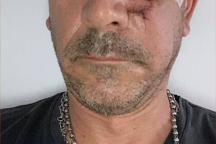 Violencia en Mendoza: le dijo que no necesitaba que le limpiara el vidrio del auto y el agresor lo atacó a palazos en uno de sus ojos