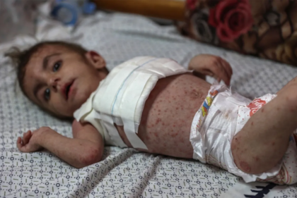 Wateen al-Adasi recibe atención médica en el Hospital Kamal Adwan en Beit Lahiya, al norte de la Franja de Gaza. La bebé desarrolló una enfermedad cutánea por higiene deficiente.