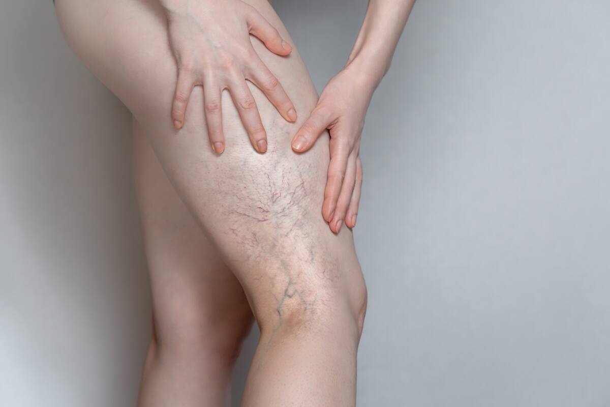 Woman shows leg with varicose veins. The concept of human health and disease. Gray background.