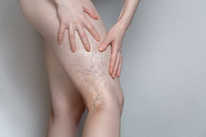 Woman shows leg with varicose veins. The concept of human health and disease. Gray background.