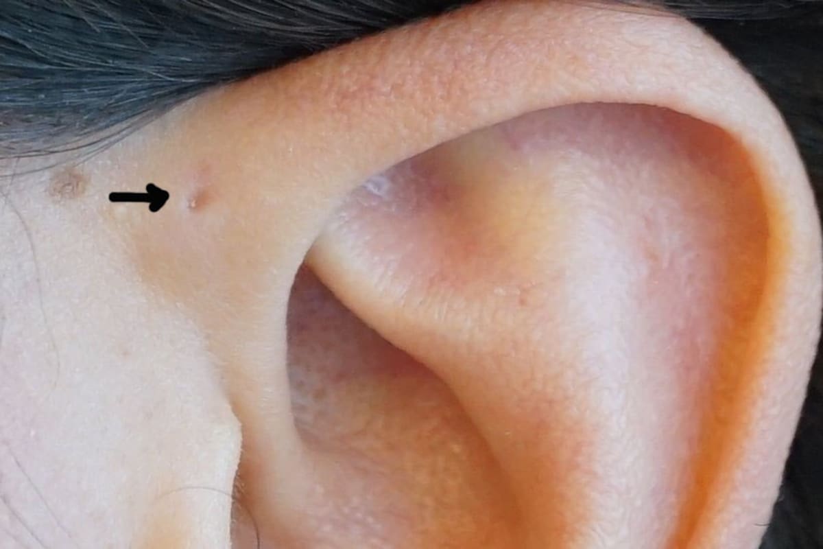 ¿Ya te fijaste si tienes un seno preauricular?