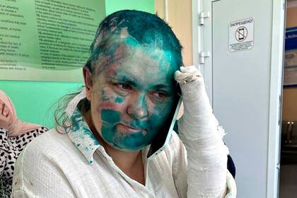 Yelena Milashina fue fotografiada con un antiséptico verde cubriendo su cara