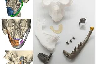 Las prótesis se realizan en base a imágenes de tomografías.